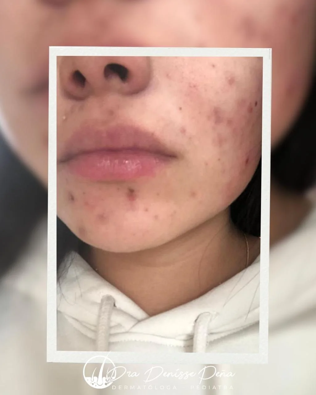 Acné en adolescente — Dermatología Pediátrica Guadalajara