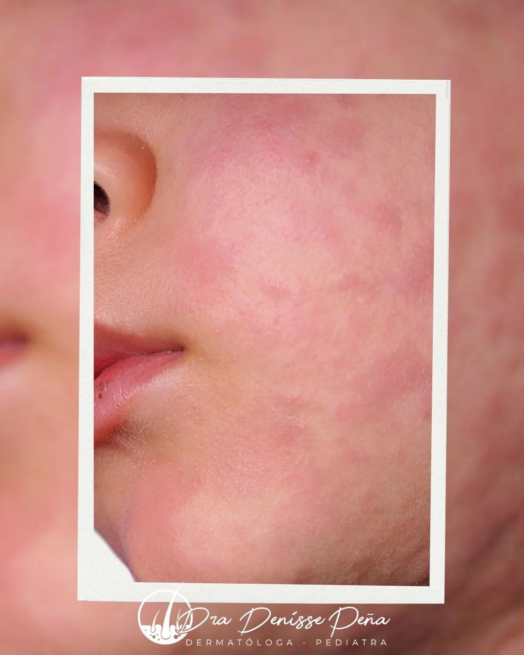 Alergias cutáneas en niños — urticaria y dermatitis de contacto