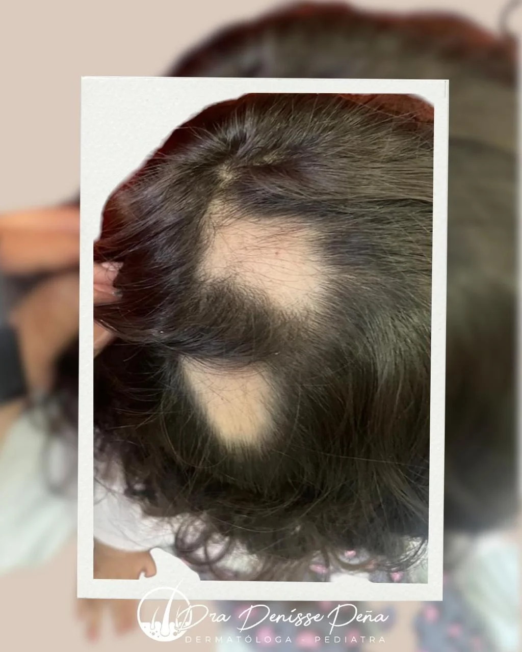Alopecia areata en niño — Dermatología Pediátrica Guadalajara