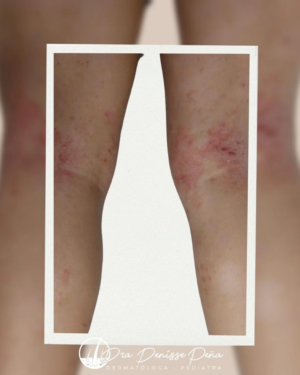 Dermatitis atópica en niño — Dermatología Pediátrica Guadalajara