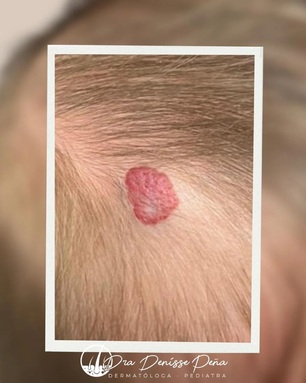 Hemangioma en bebé — Dermatología Pediátrica Guadalajara