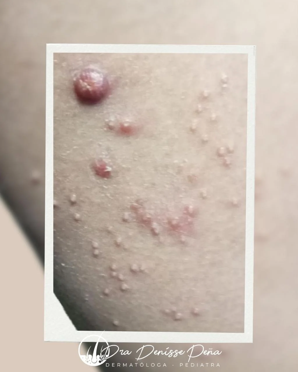 Molusco contagioso en niño — Dermatología Pediátrica Guadalajara