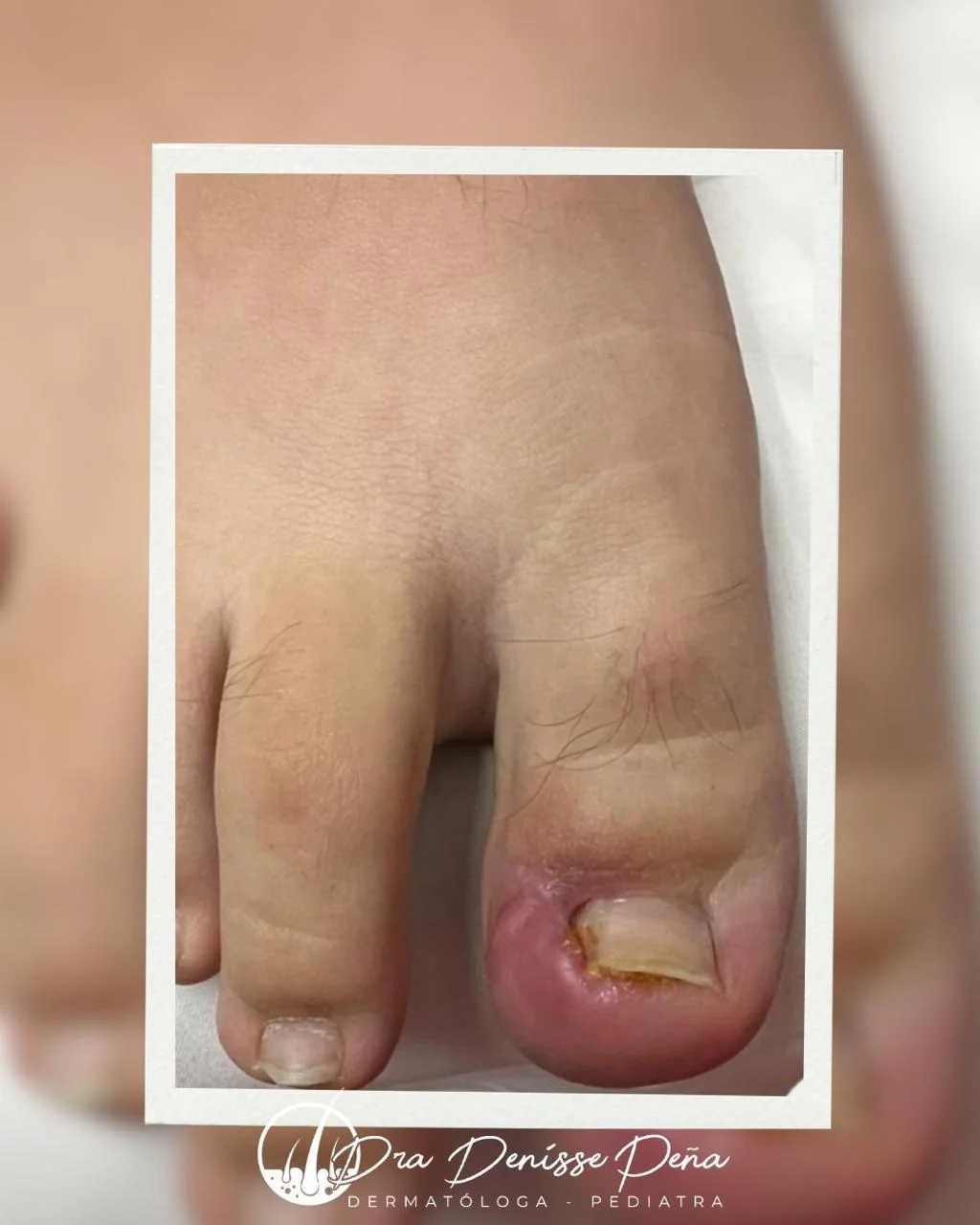 Onicocriptosis en adolescente — Dermatología Pediátrica Guadalajara