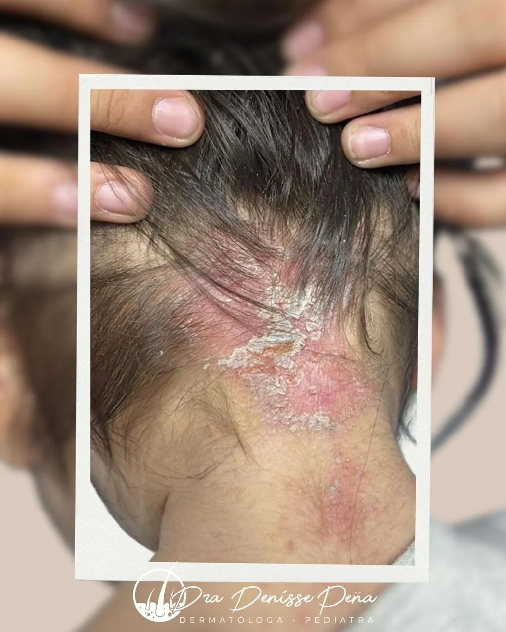 Psoriasis en niño — Dermatología Pediátrica Guadalajara