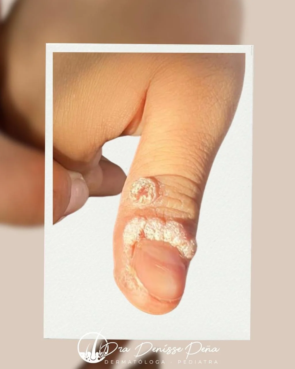 Verrugas en niño — Dermatología Pediátrica Guadalajara