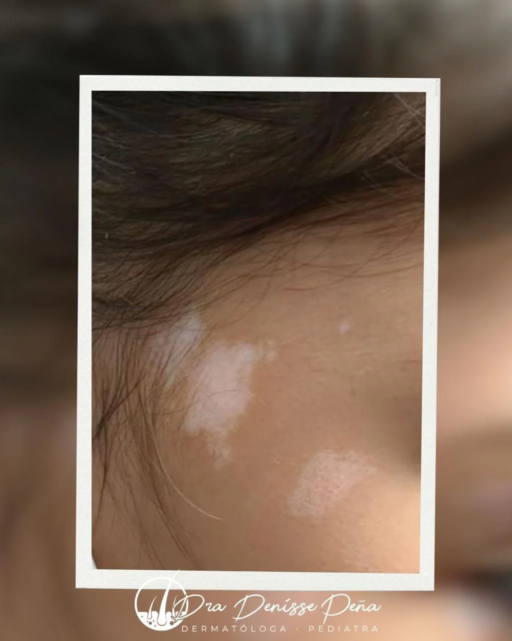 Vitiligo en niño — Dermatología Pediátrica Guadalajara